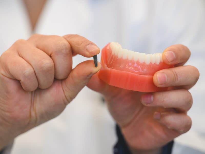 A University of Michigan dentist displays an implant overdenture. Implant overdentures involves surgically inserting small metal posts into the patient's jaw, providing a stable, permanent structure to securely hold dentures in place. 